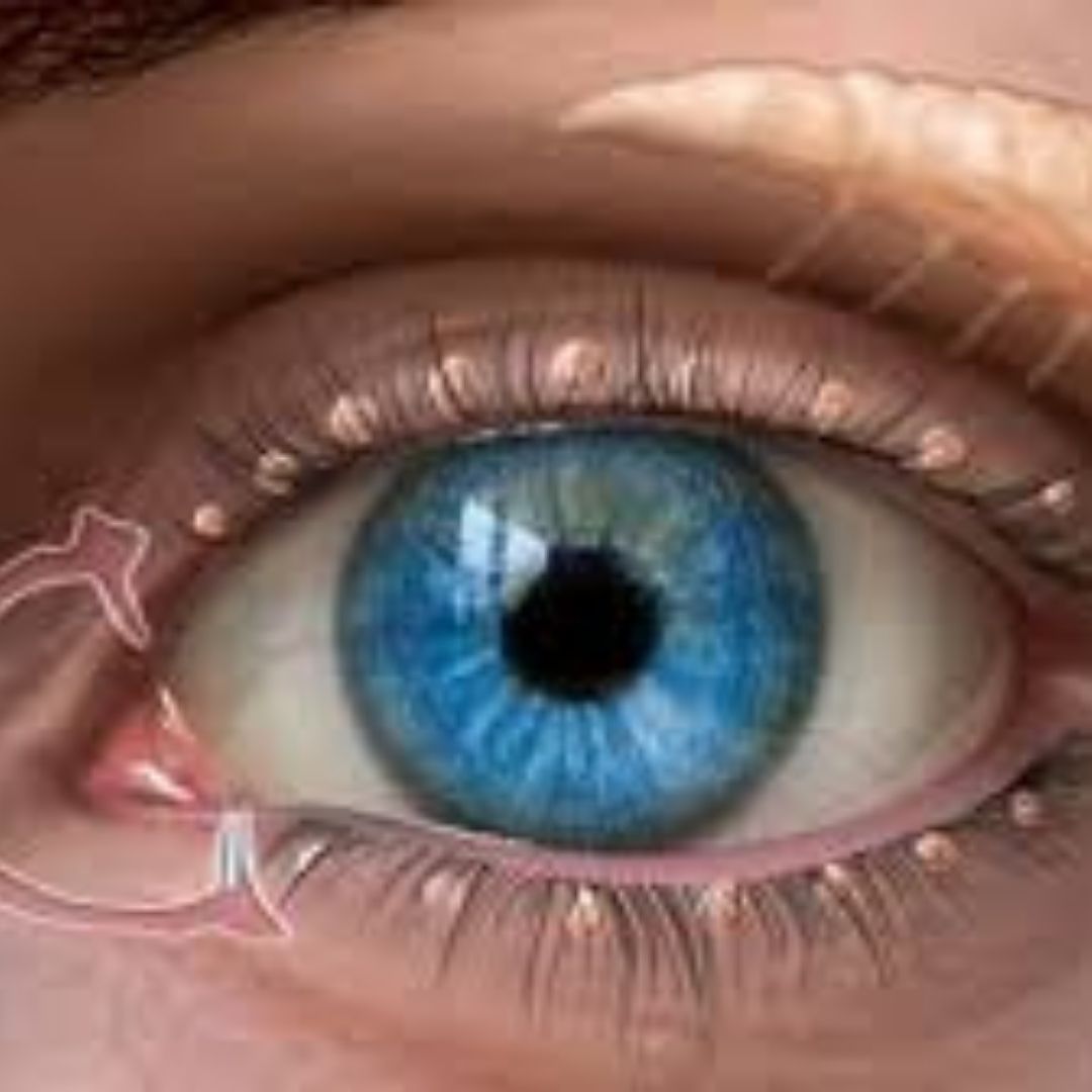 gözyaşı kanalı açma masajı günde kaç kez ve nasıl uygulanmalı