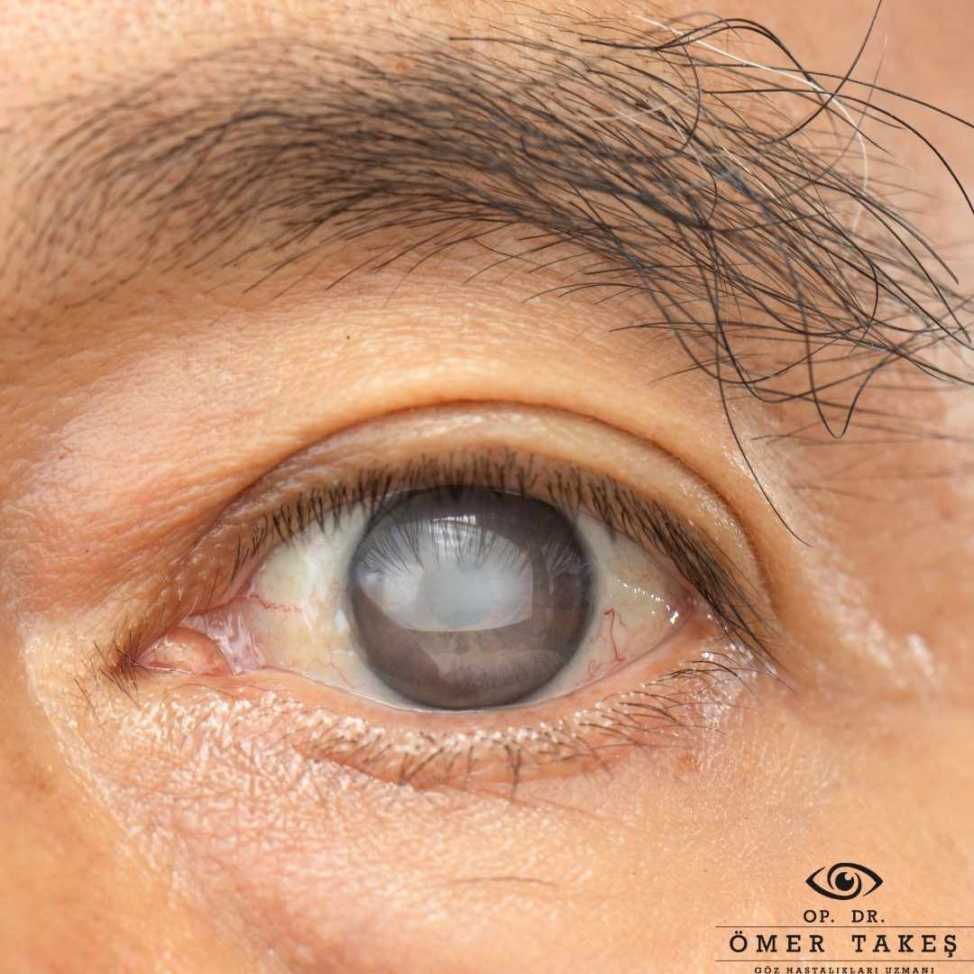 Katarakt ameliyatı sonrası hangi şikayetler görülür