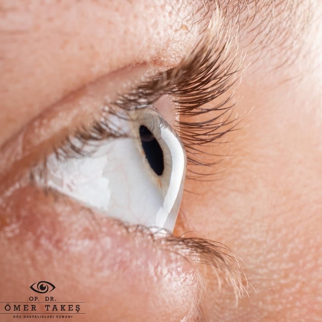 Keratokonus Hasta Yorumları