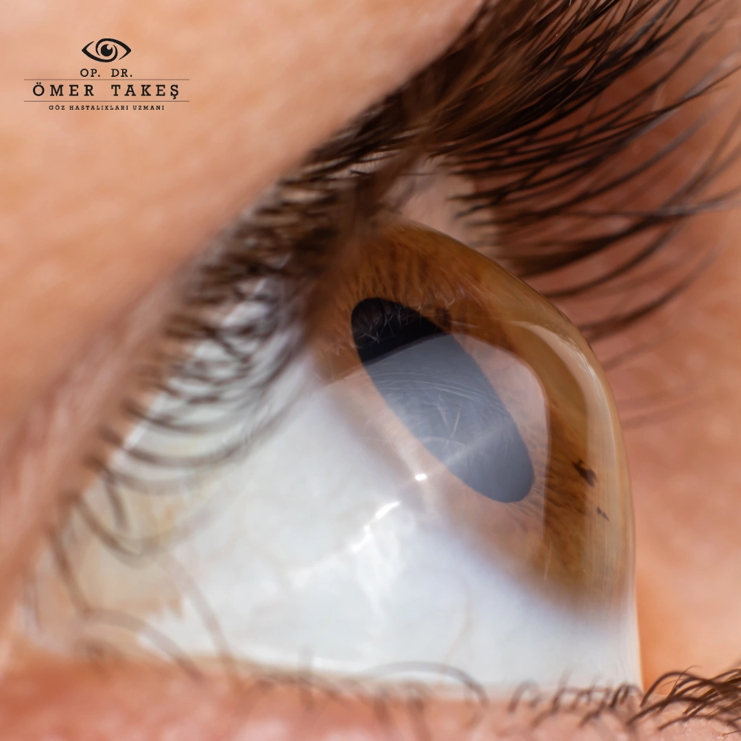 Keratokonus Nedir?