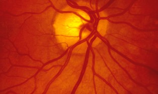 Retina Ameliyatı Nedir? Nasıl Uygulanır?