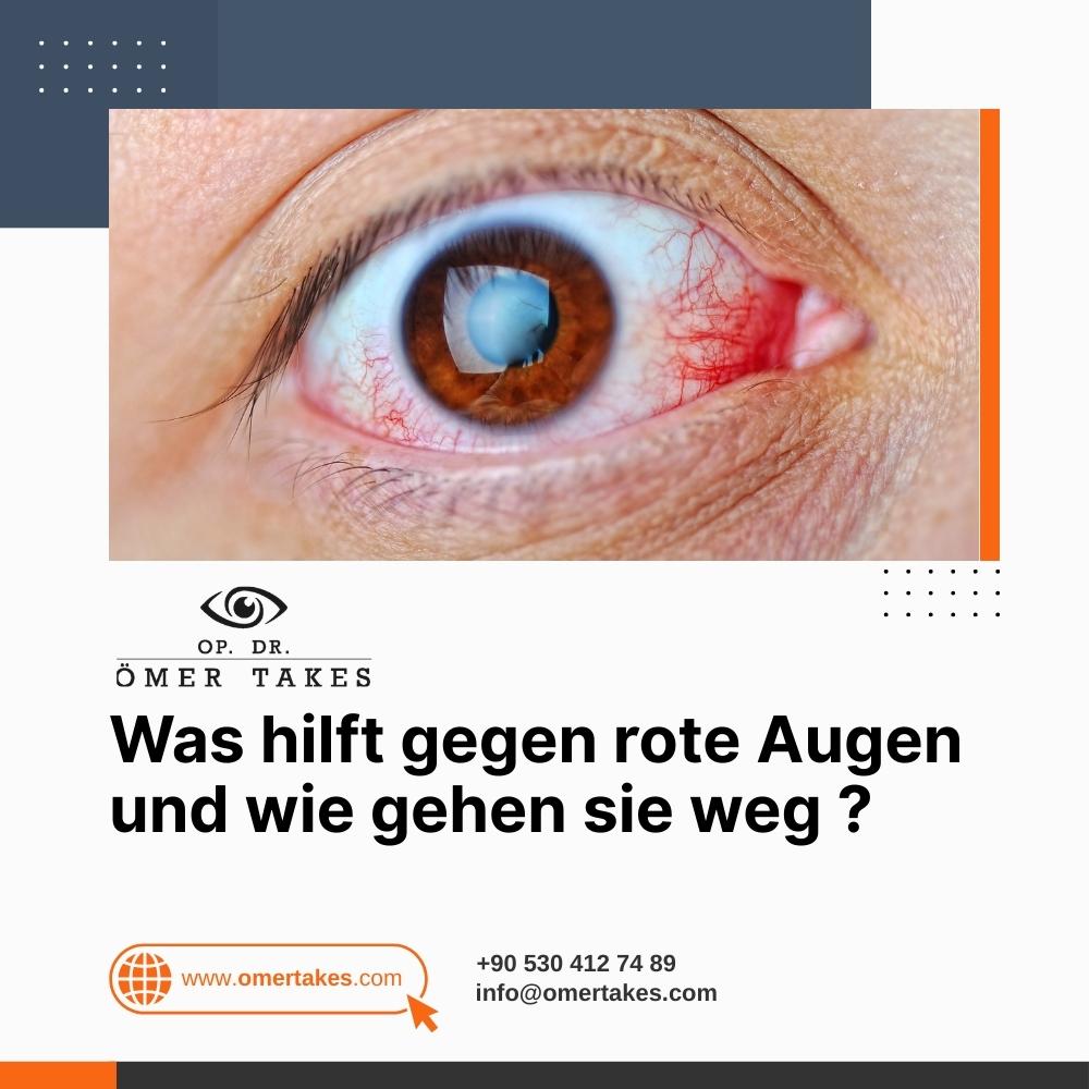 Was-hilft-gegen-rote-Augen-und-wie-gehen-sie-weg.jpg