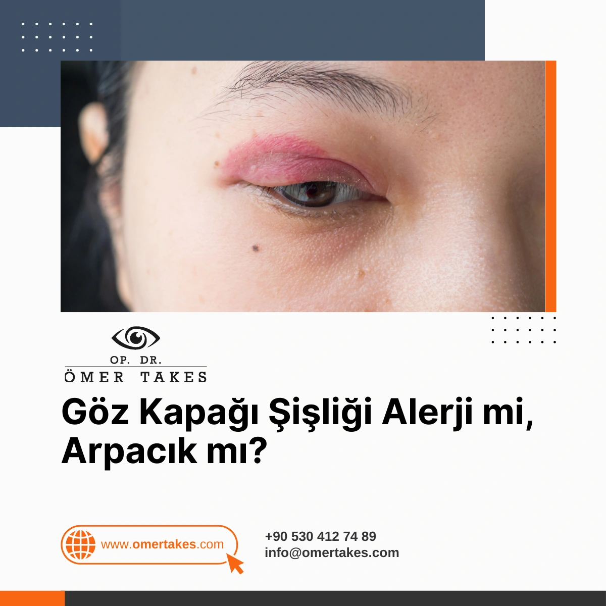 göz kapağı şişlik