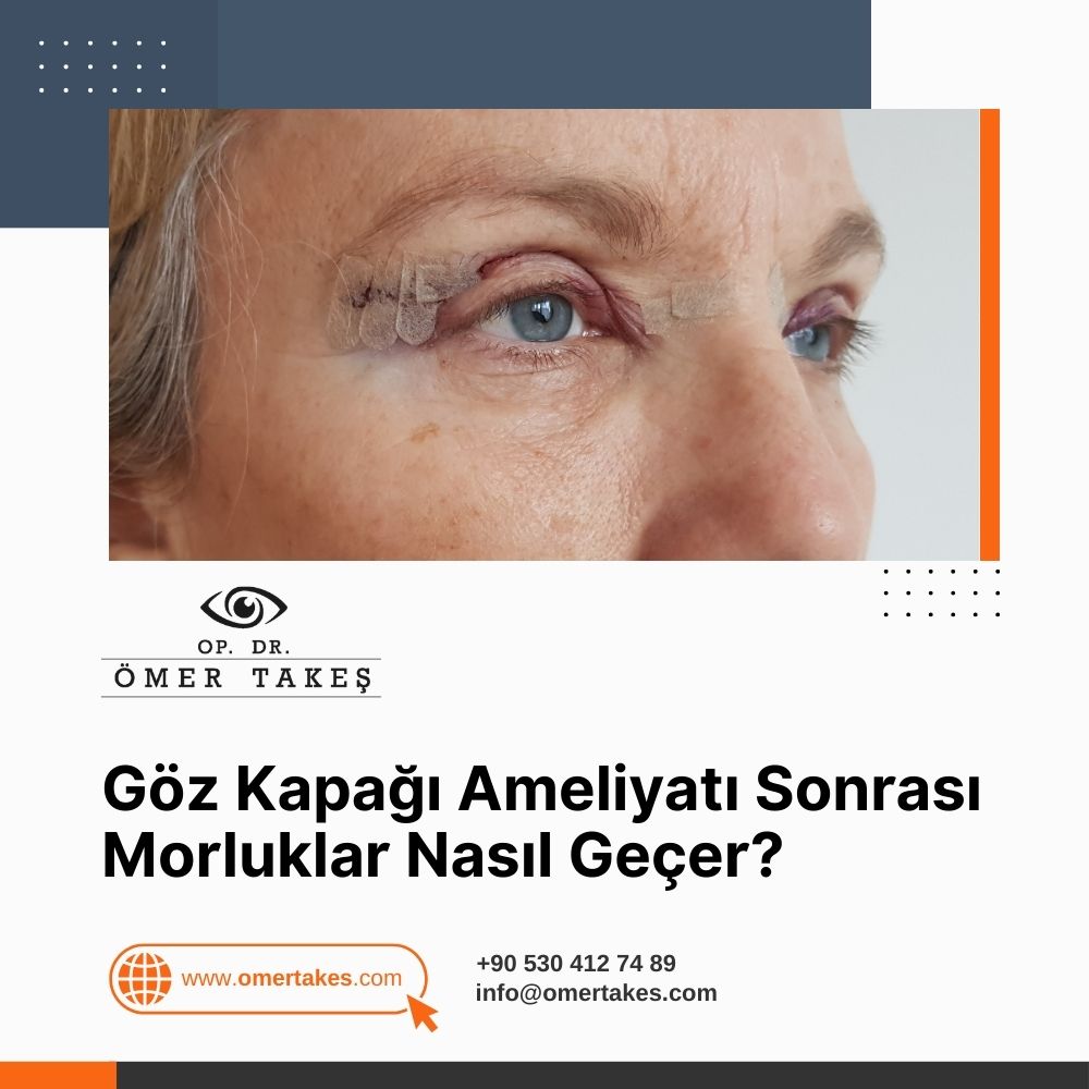 Göz Kapağı Ameliyatı Sonrası Morluklar Nasıl Geçer