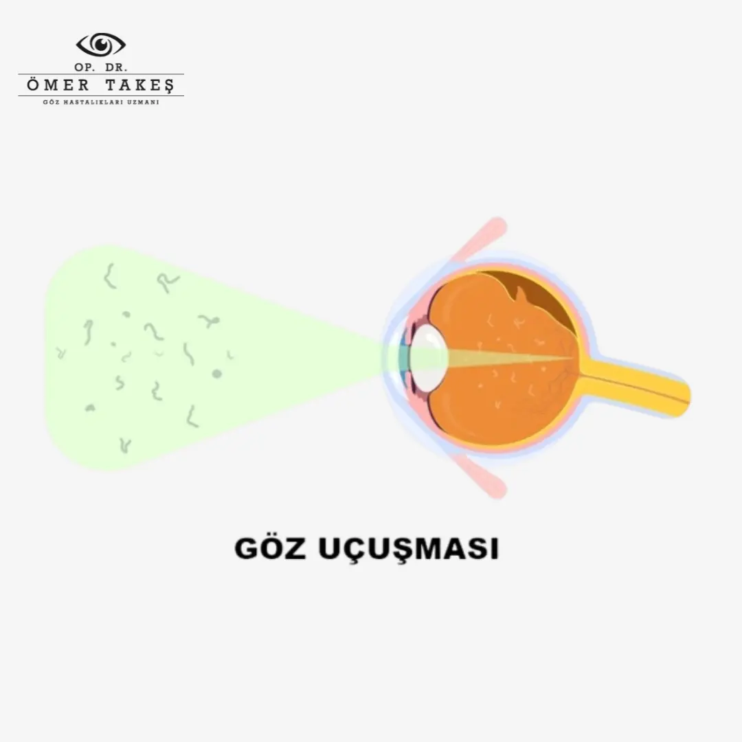 göz uçuşması nedir