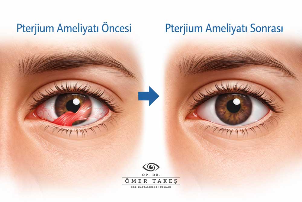 Pterjium ameliyatı olanlar Kadınlar Kulübü