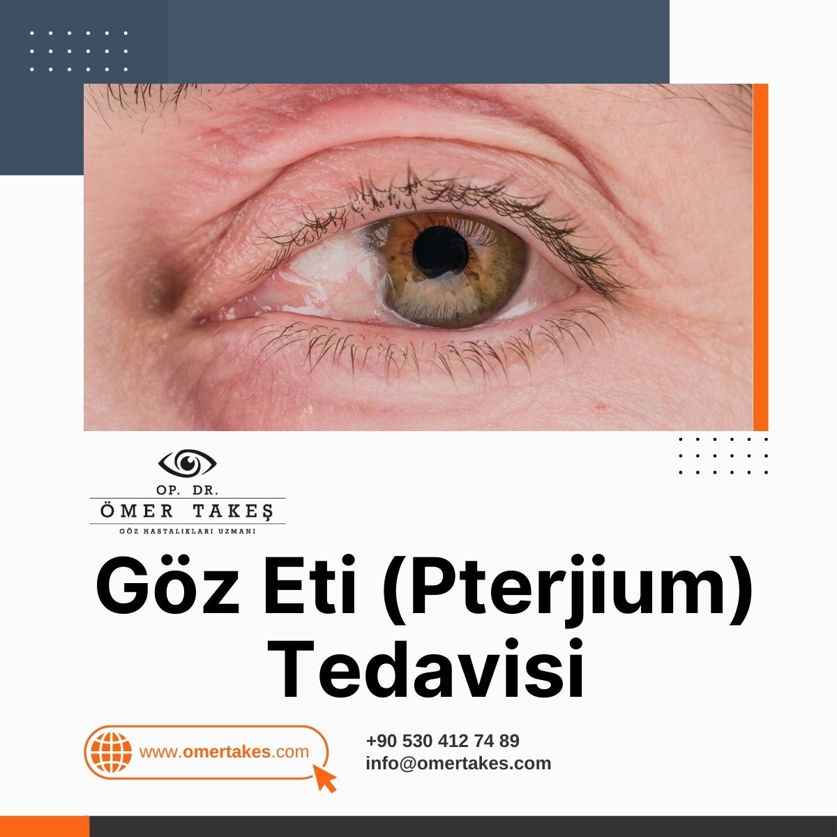 Pterjium'a ne sebep olur?
