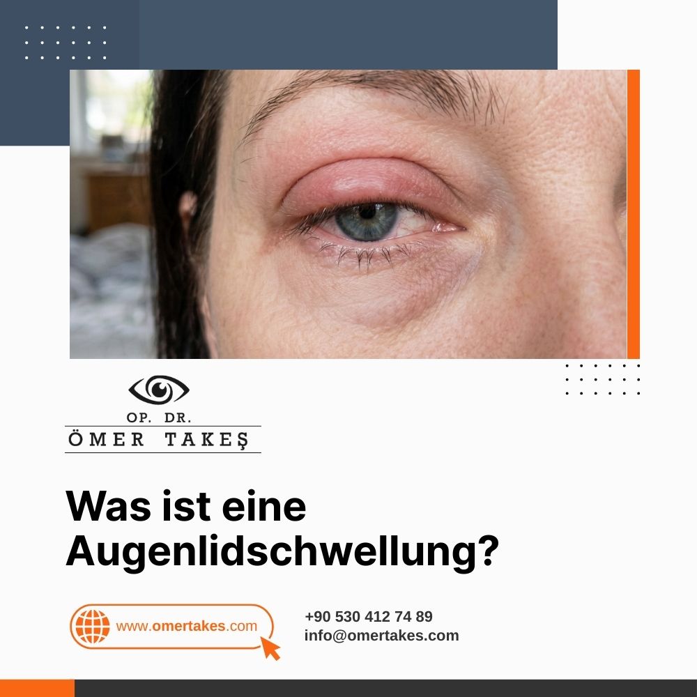 Was ist eine Augenlidschwellung