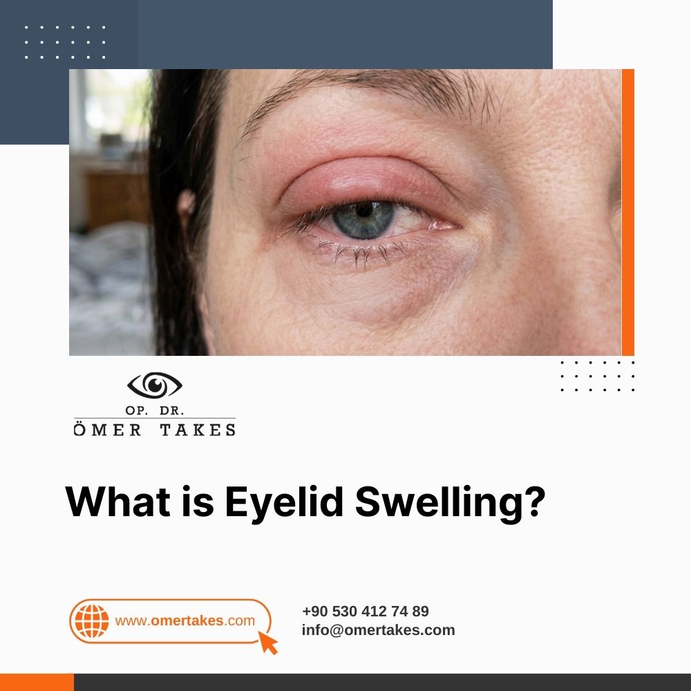 What is Eyelid Swelling