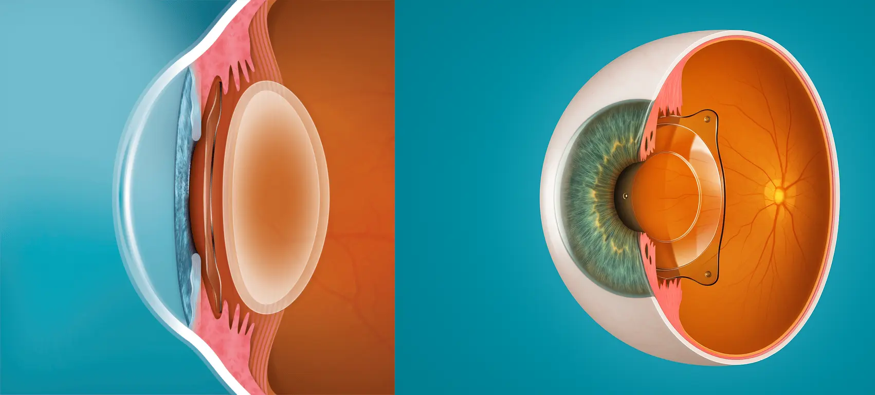 fakik göz içi lens ameliyatı yorumları