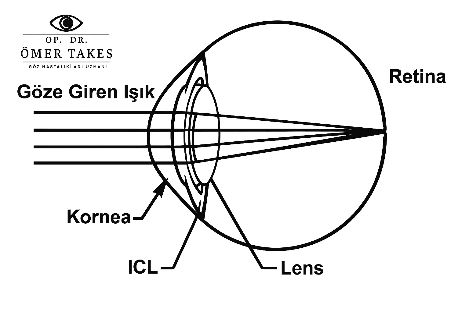 fakik göz içi lens