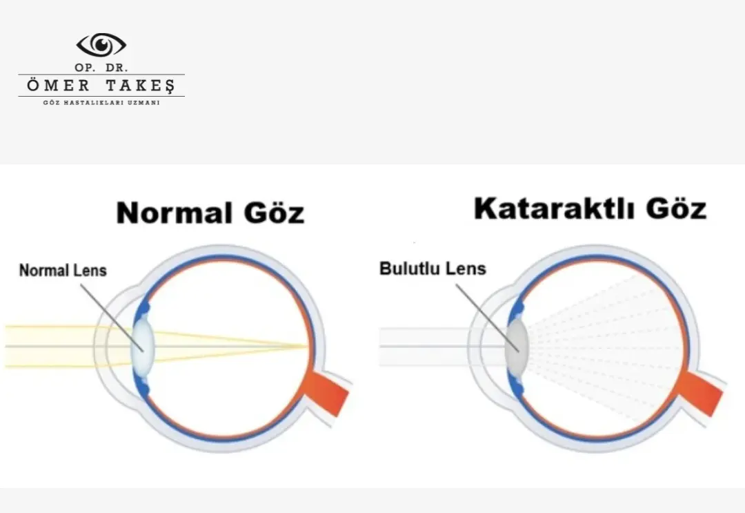 katarakt ameliyatı sonrası ışık yansıması
