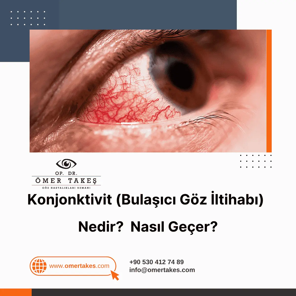 Konjonktivit nedir
