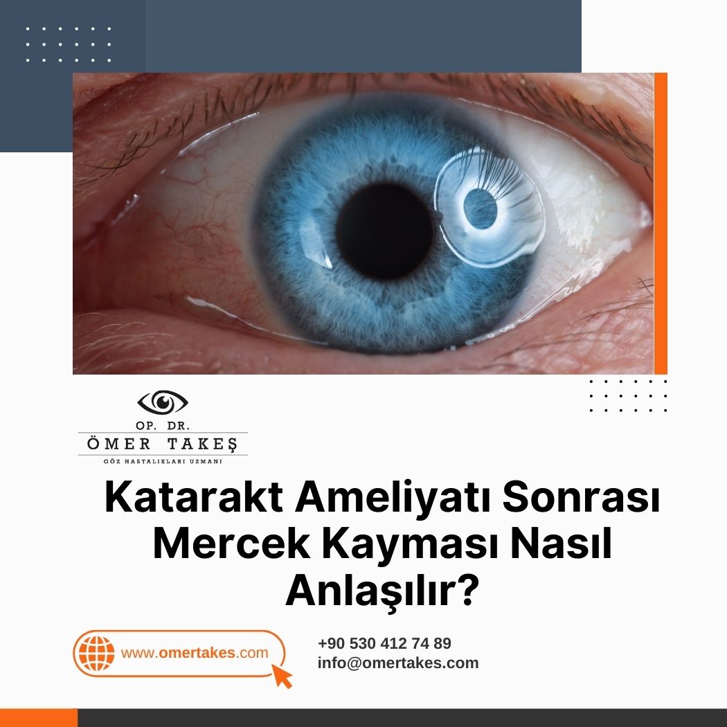 Katarakt Ameliyatı Sonrası Mercek Kayması Nasıl Anlaşılır?