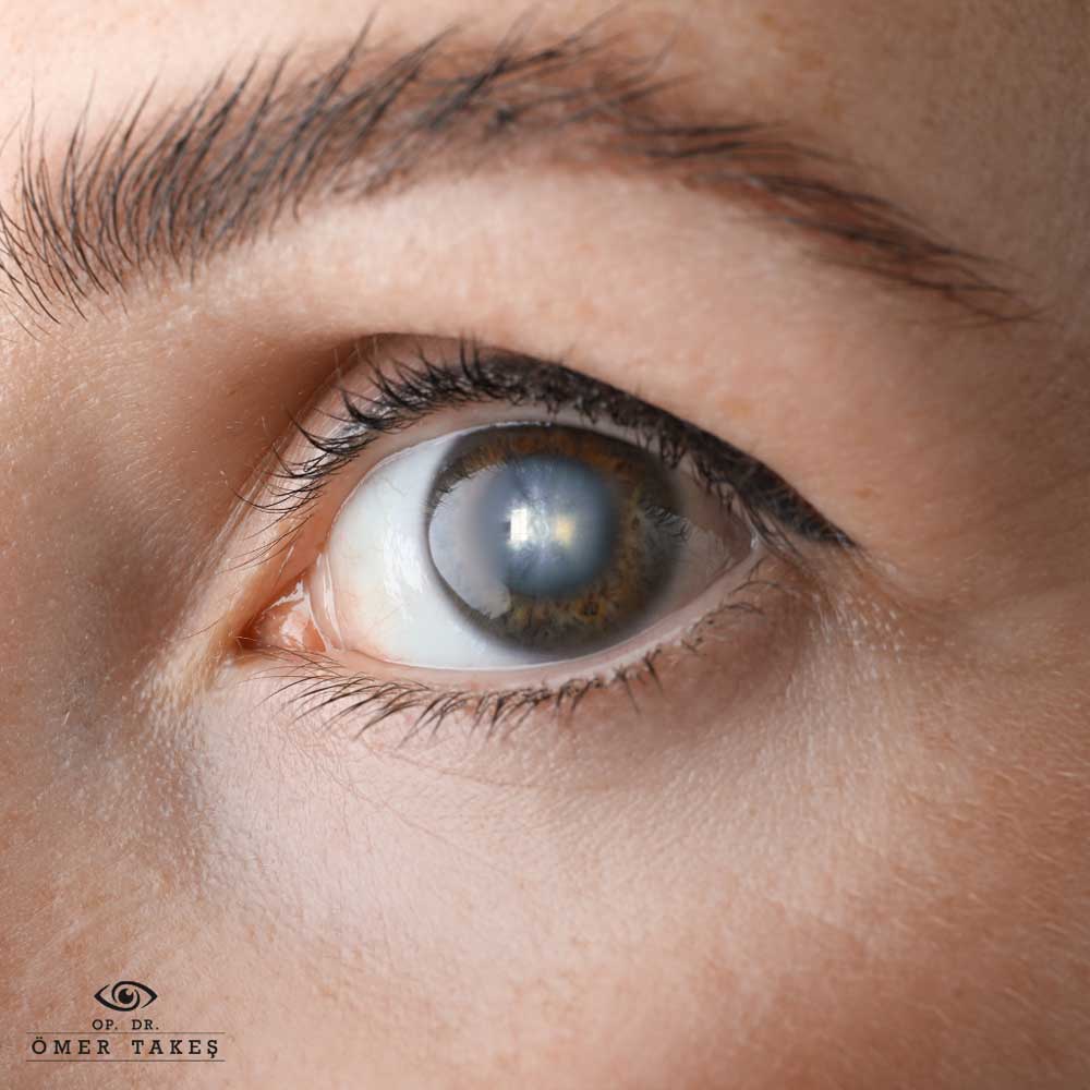 katarakt ameliyatı sonrası göz damlası