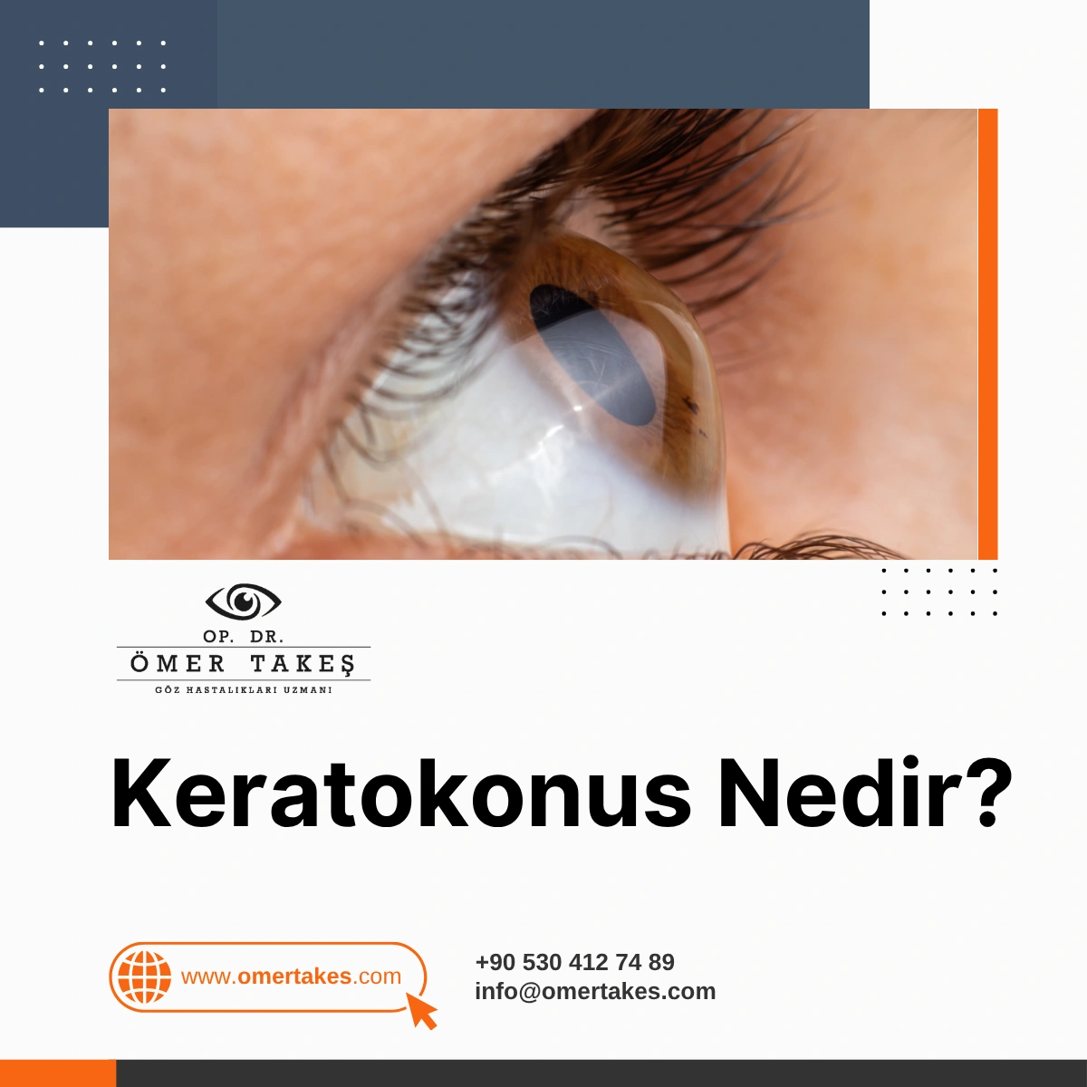 Keratokonus Körlük Yapar Mı? kadınlar kulubü