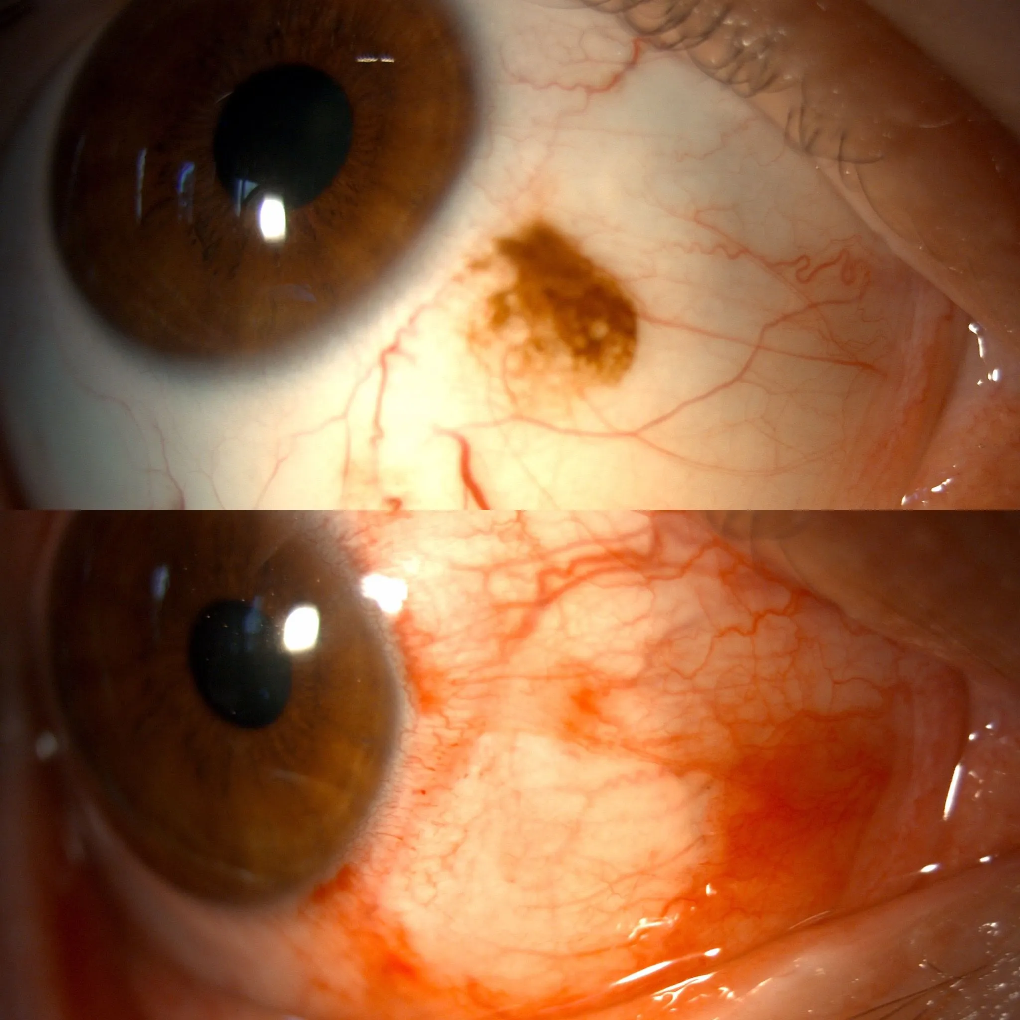 Konjonktival nevüs tedavisi nasıl yapılır