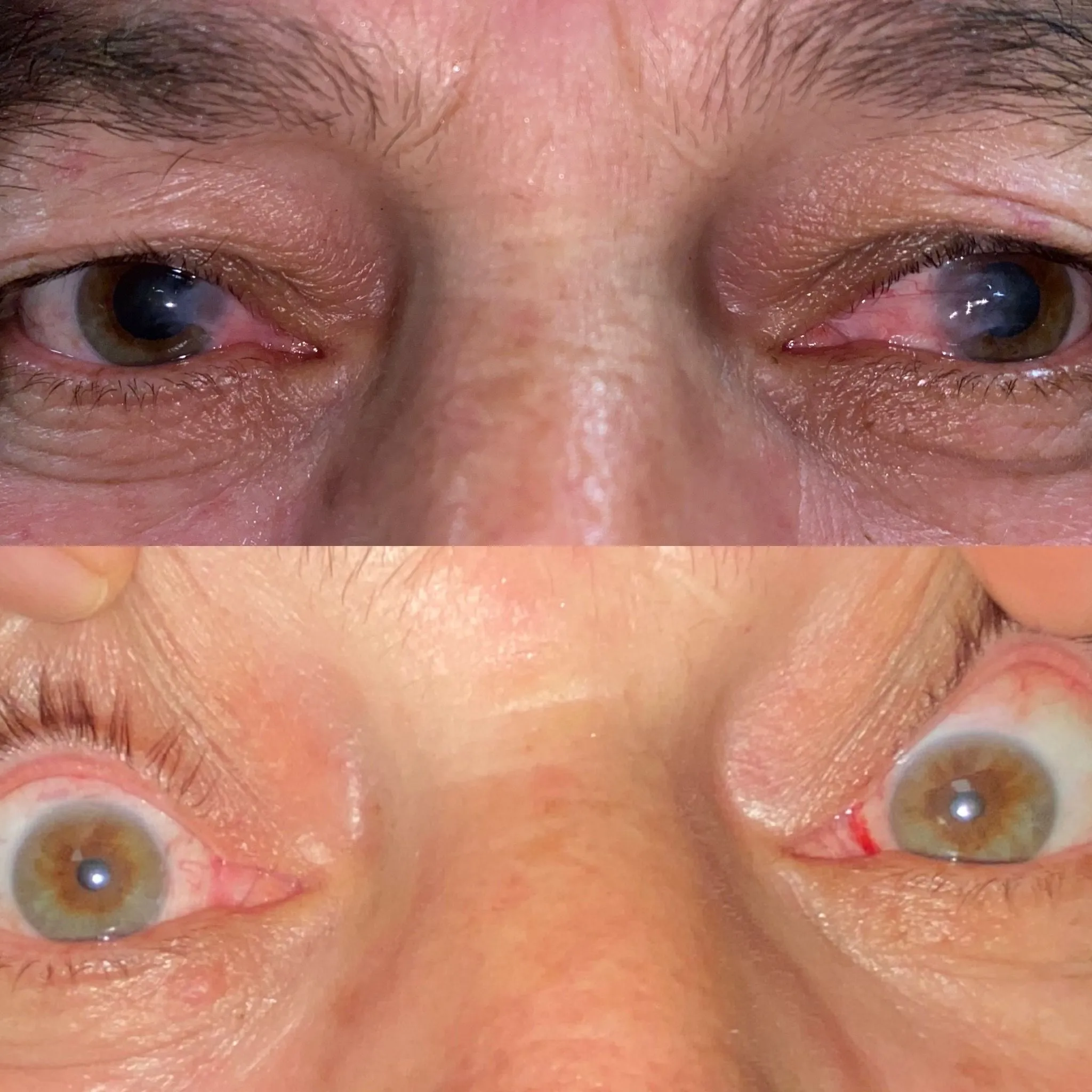 pterjium ameliyatı sonrası yorumlar