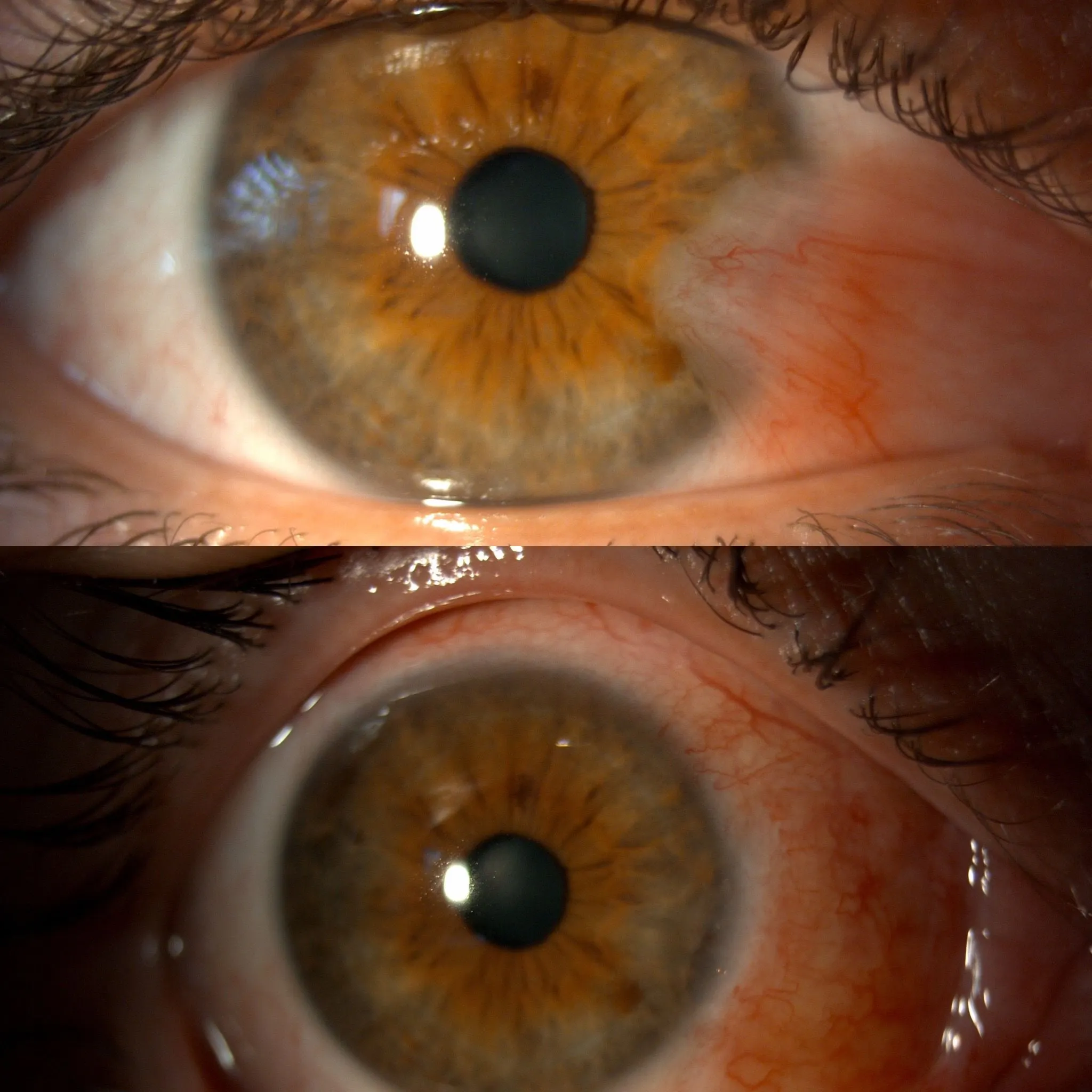 pterjium ameliyatı olanlar kadınlar kulübü