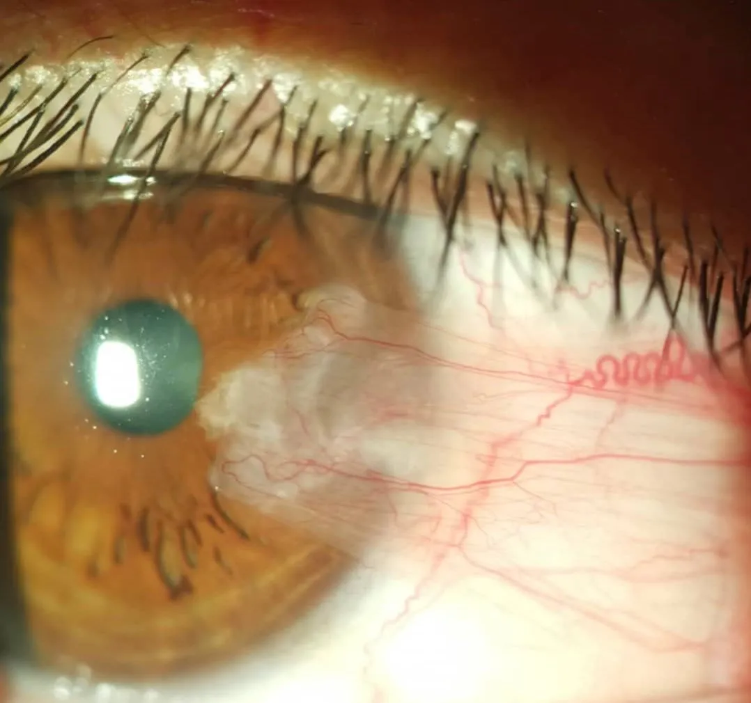 pterjium ameliyatı riskleri