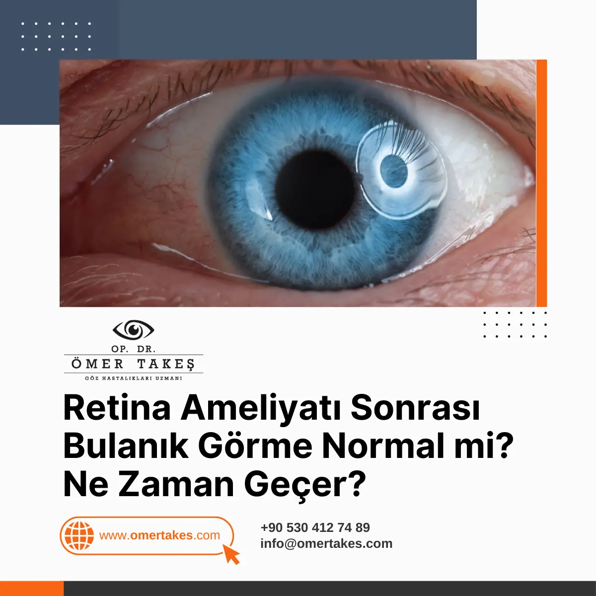 dekolman nedir